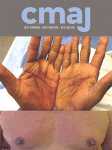 Treatment of subclinical hypothyroidism in pregnant women