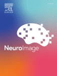 Spinal cord stimulation improves brain connectivity and consciousness level in patients with disorders of consciousness