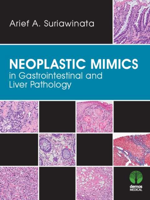 Neoplastic mimics in gastrointestinal and liver pathology